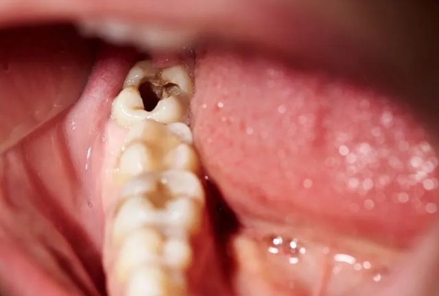 Người đàn ông 57 tuổi bị sùi van tim vì chủ quan với sâu răng: Bất ngờ vì những biến chứng! - Ảnh 2.